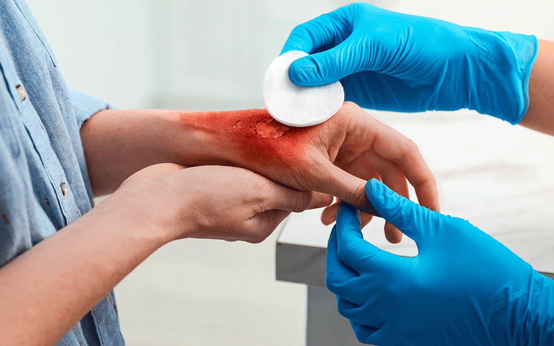 Cirugía Plástica Estética de quemados