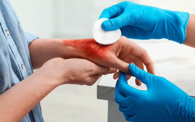 Cirugía Plástica Estética de quemados