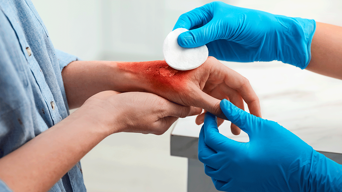 Cirugía Plástica Estética de quemados